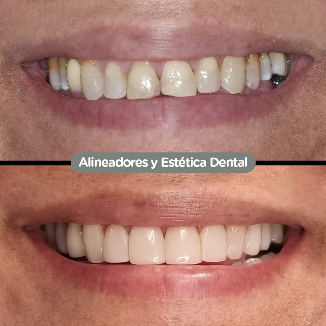 Caso de Invisalign en Dental Group Panama