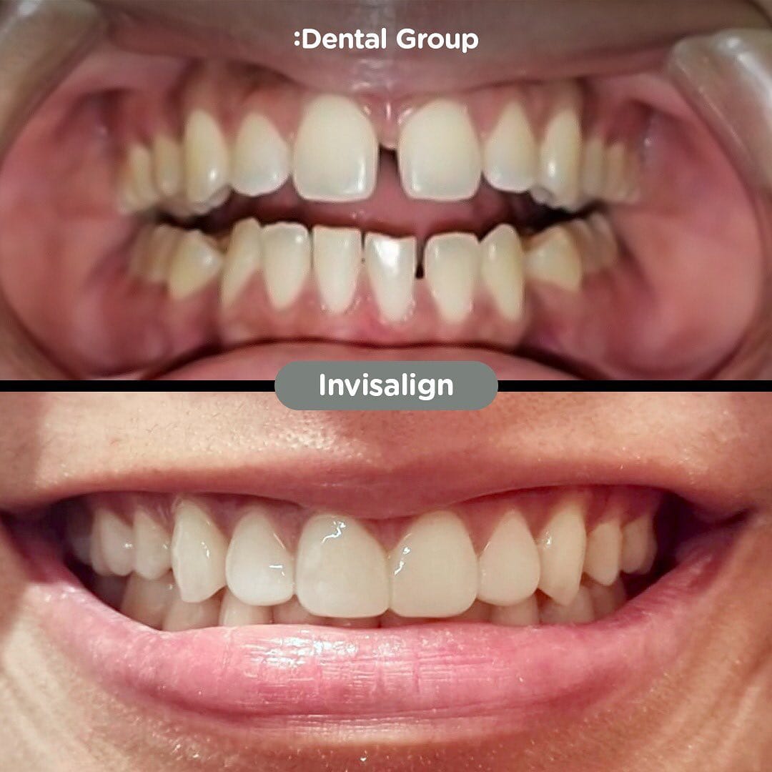 Caso de Invisalign en Dental Group Panama
