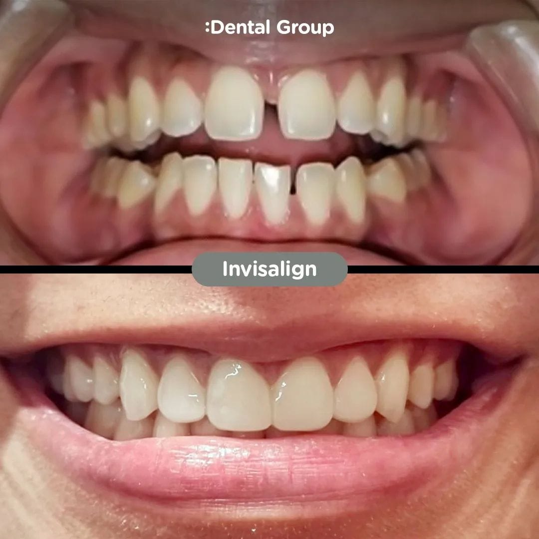 Antes y después con alineadores invisibles tipo Invisalign en Dental Group Panama