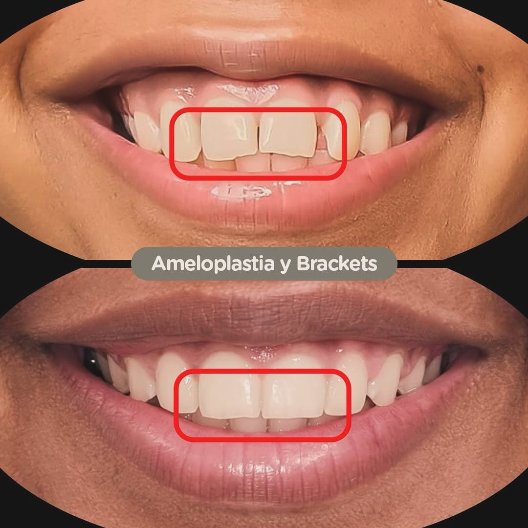Ameloplastia y recontorno estético post-ortodoncia