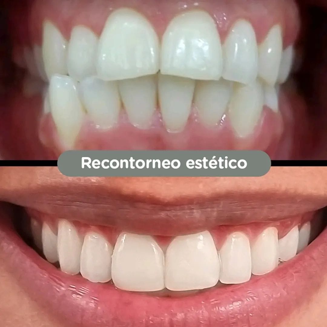 Antes y después de ameloplastia (recontorneado estético) en Dental Group Panama