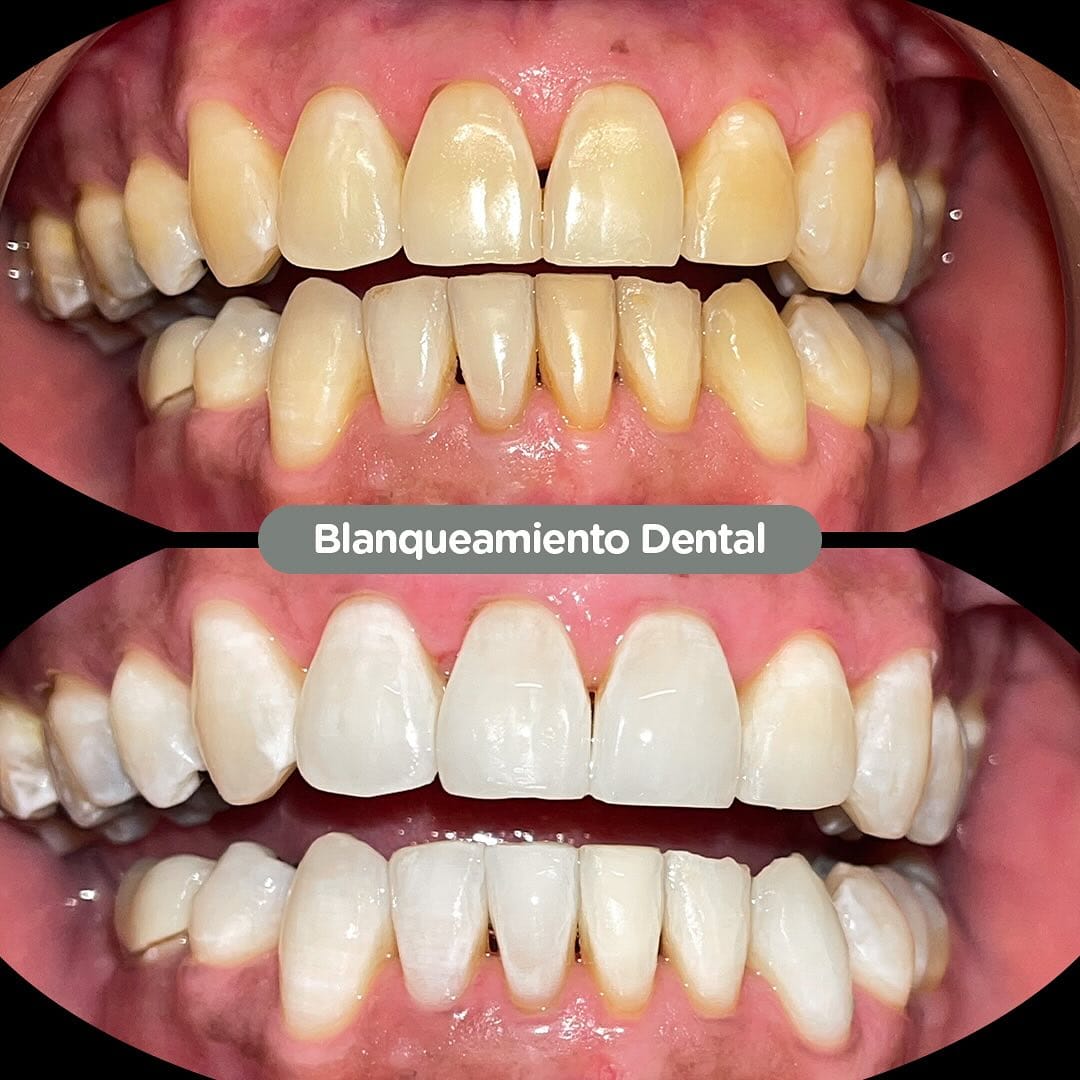 Blanqueamiento dental en consultorio