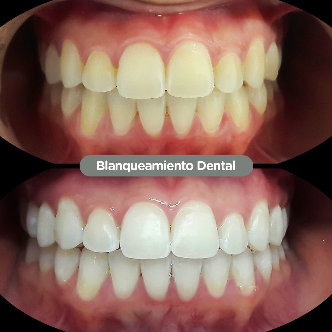 Resultado de Blanqueamiento en consultorio en Dental Group Panama