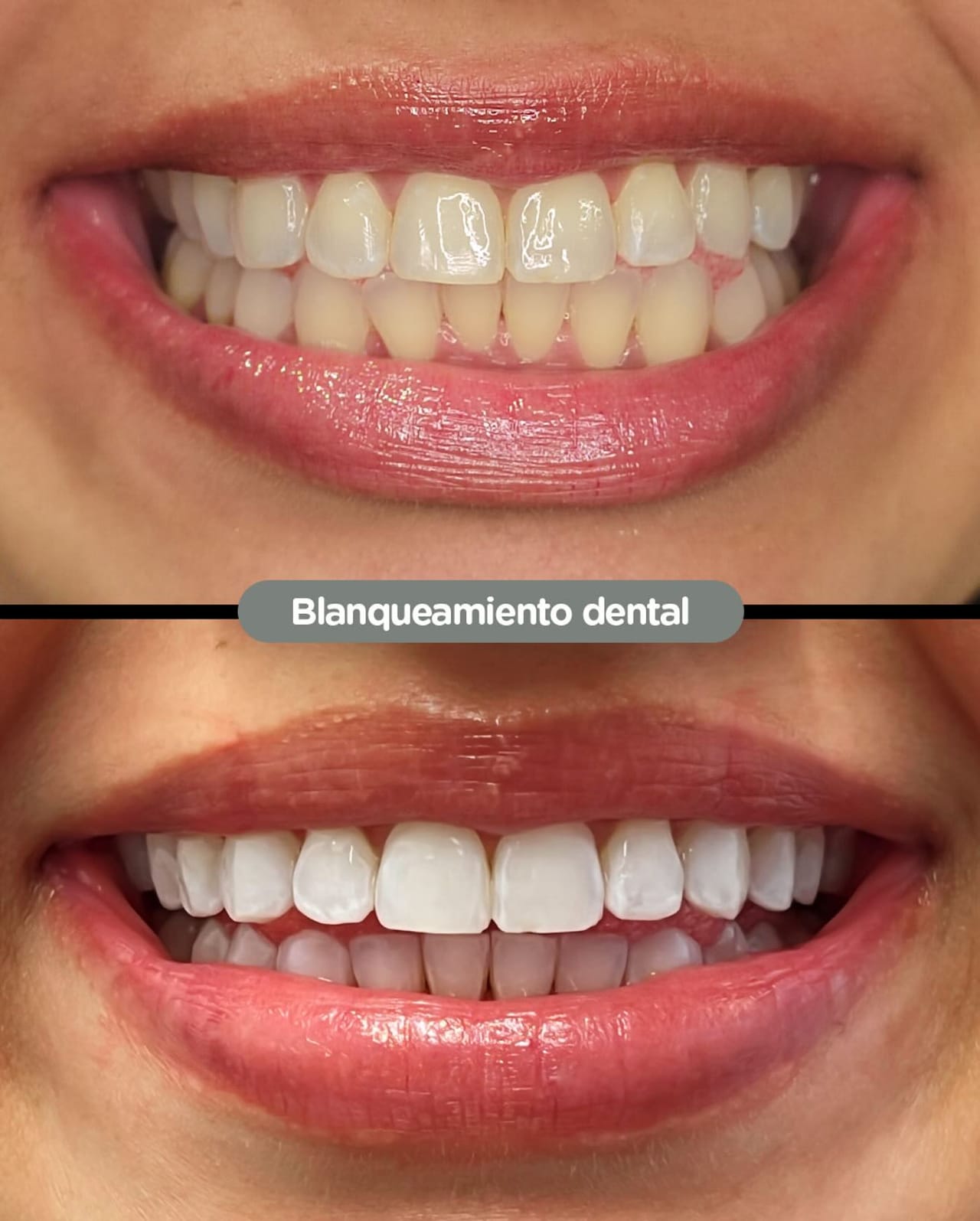 Antes y después de blanqueamiento dental en Dental Group Panama
