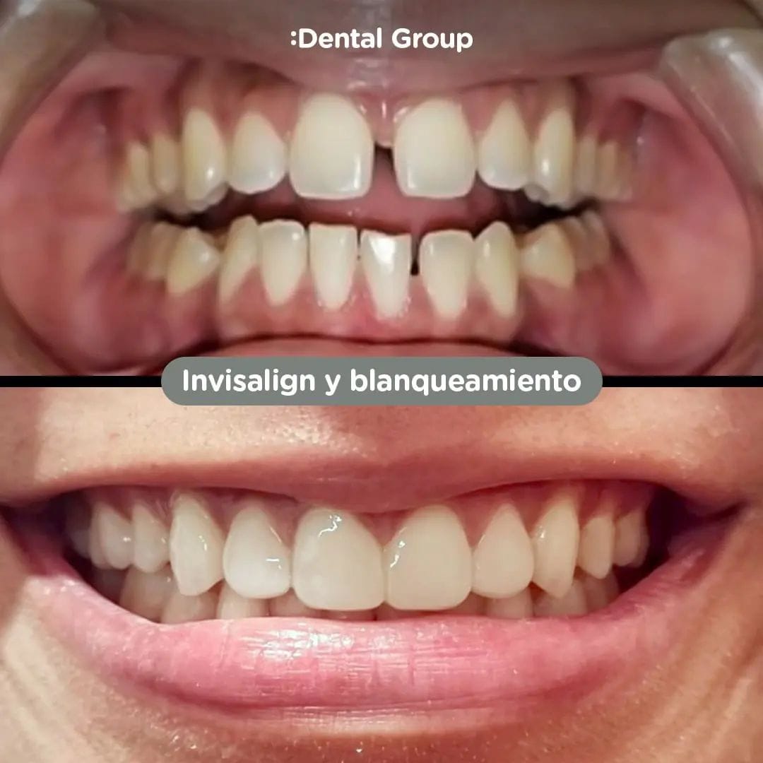 Antes y después de blanqueamiento dental en Dental Group Panama