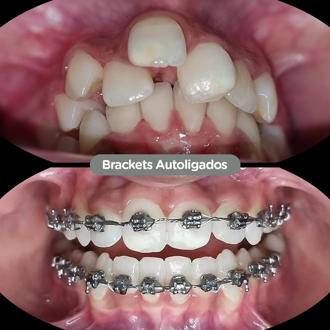 Resultado de Implantes dentales en Dental Group Panama
