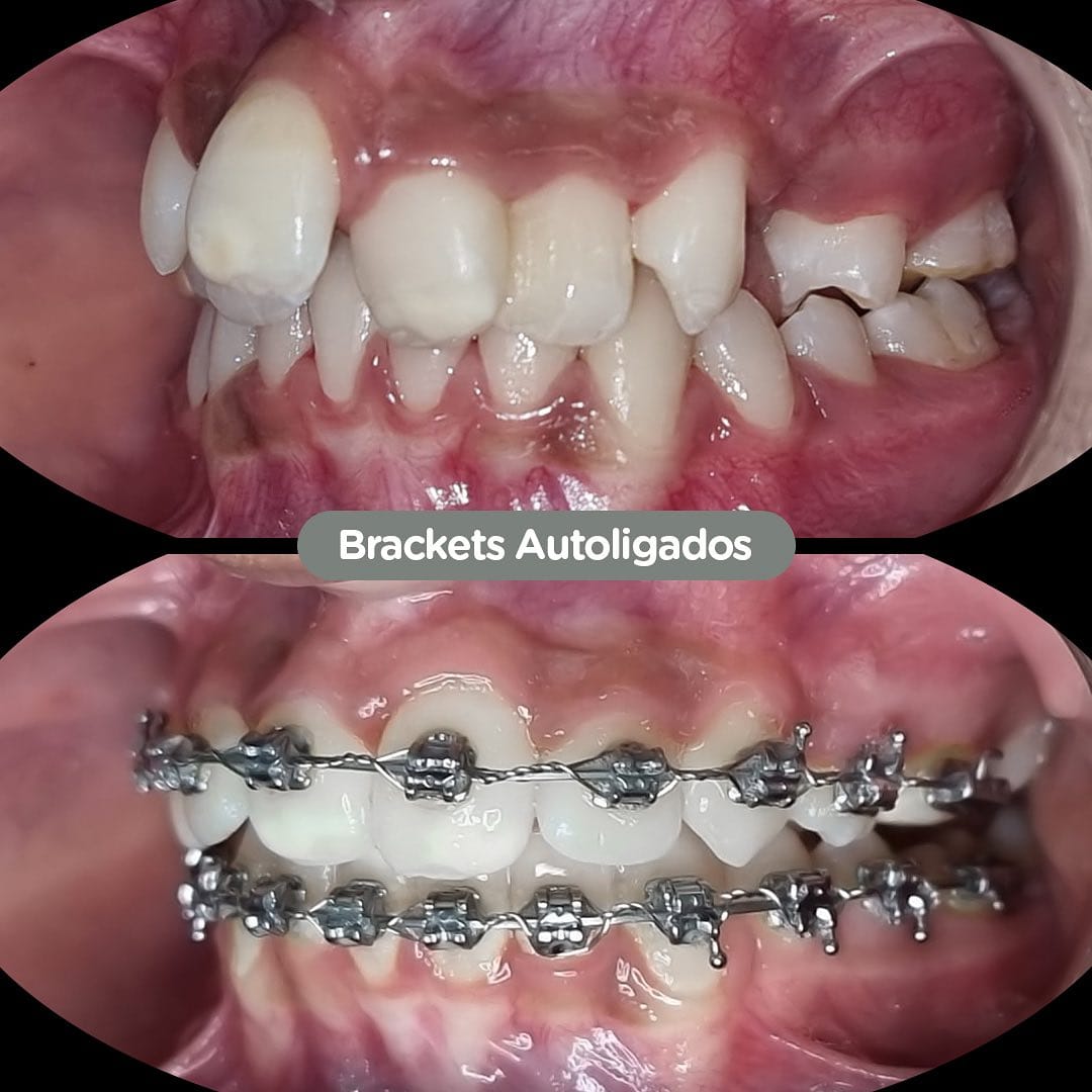 Resultado de Brackets autoligados en Dental Group Panama
