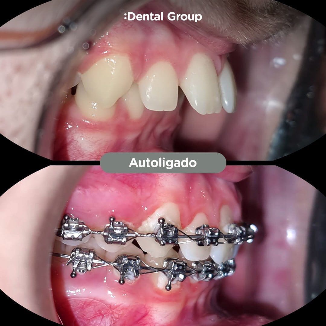 Caso de Brackets autoligados en Dental Group Panama