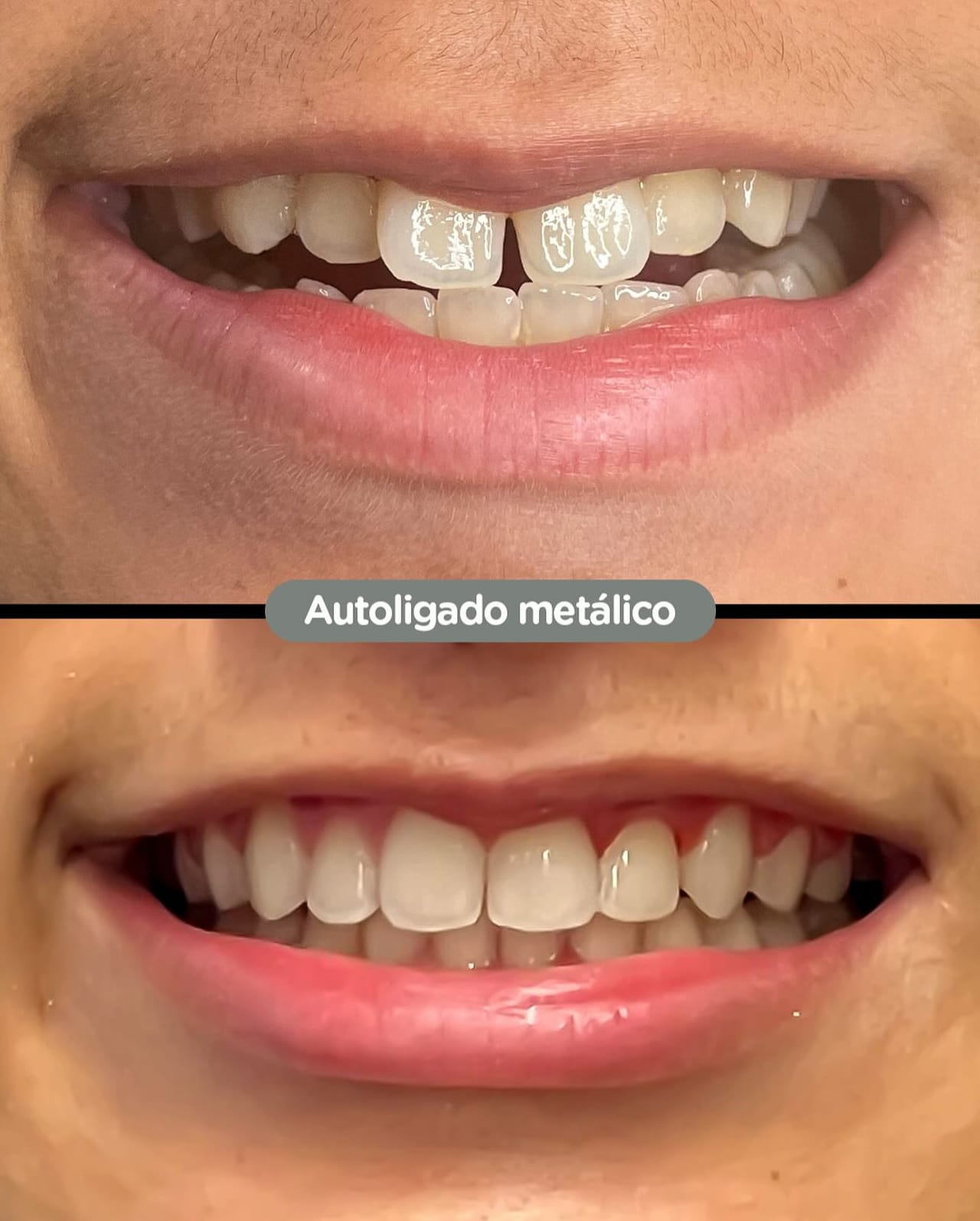Resultado de All-on-4 en Dental Group Panama