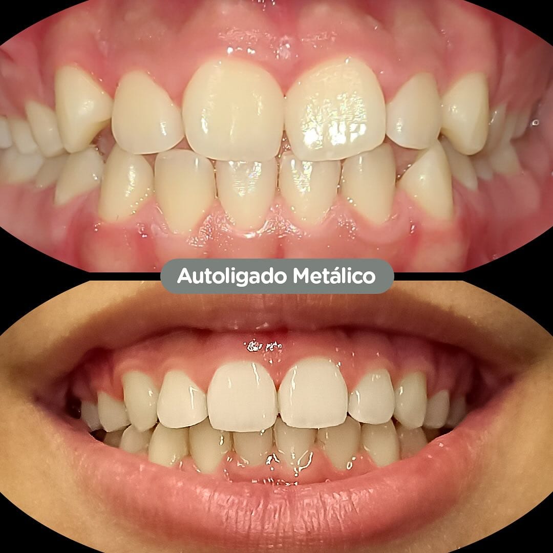 Antes y después con brackets autoligados Sistema CCO en Dental Group Panama
