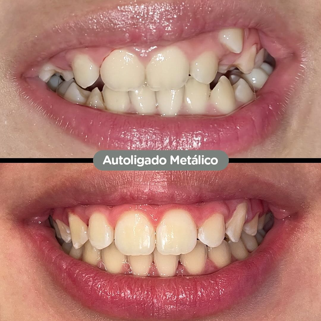 Antes y después con brackets autoligados Sistema CCO en Dental Group Panama