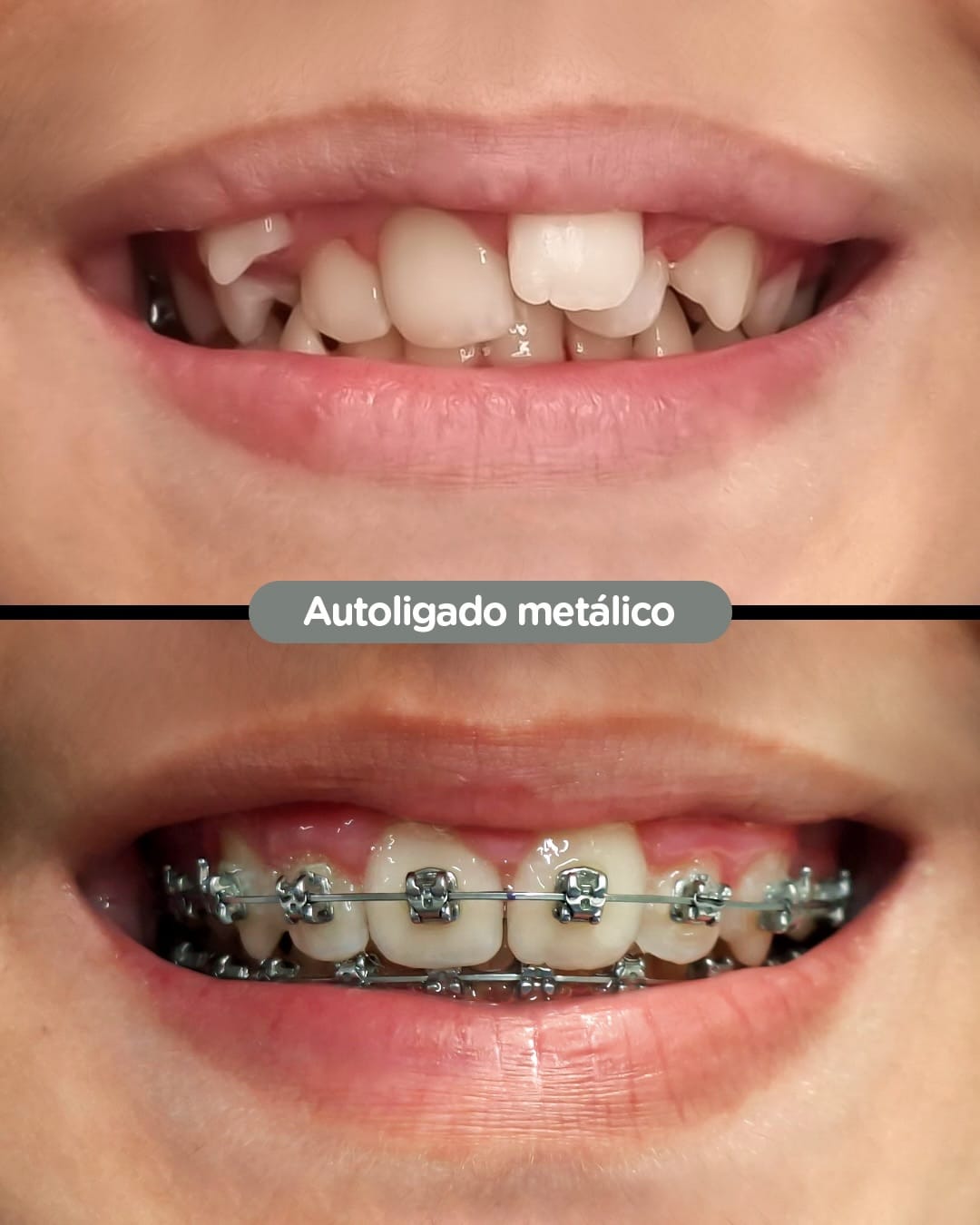 Resultado de Brackets estéticos en Dental Group Panama