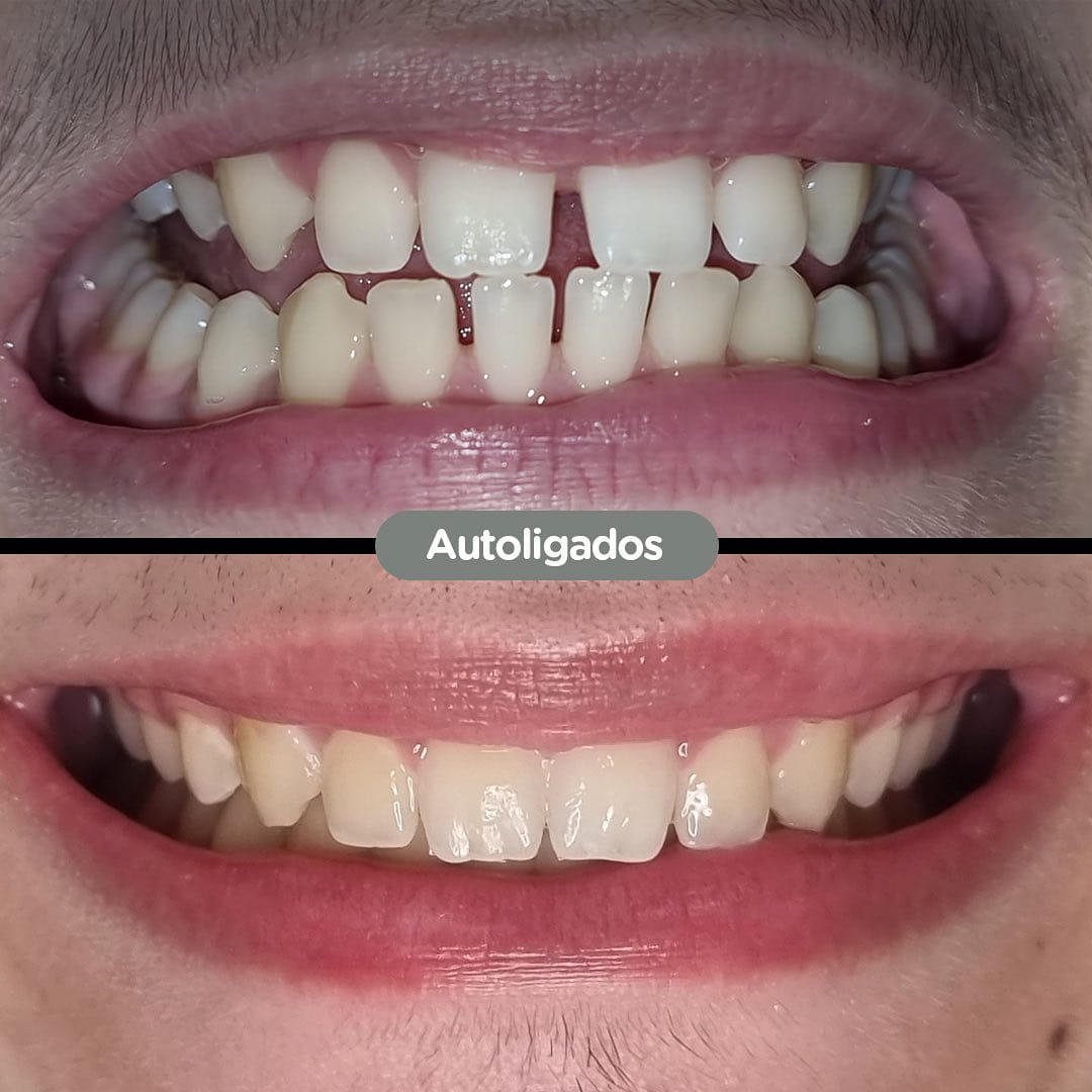 Antes y después con brackets autoligados Sistema CCO en Dental Group Panama