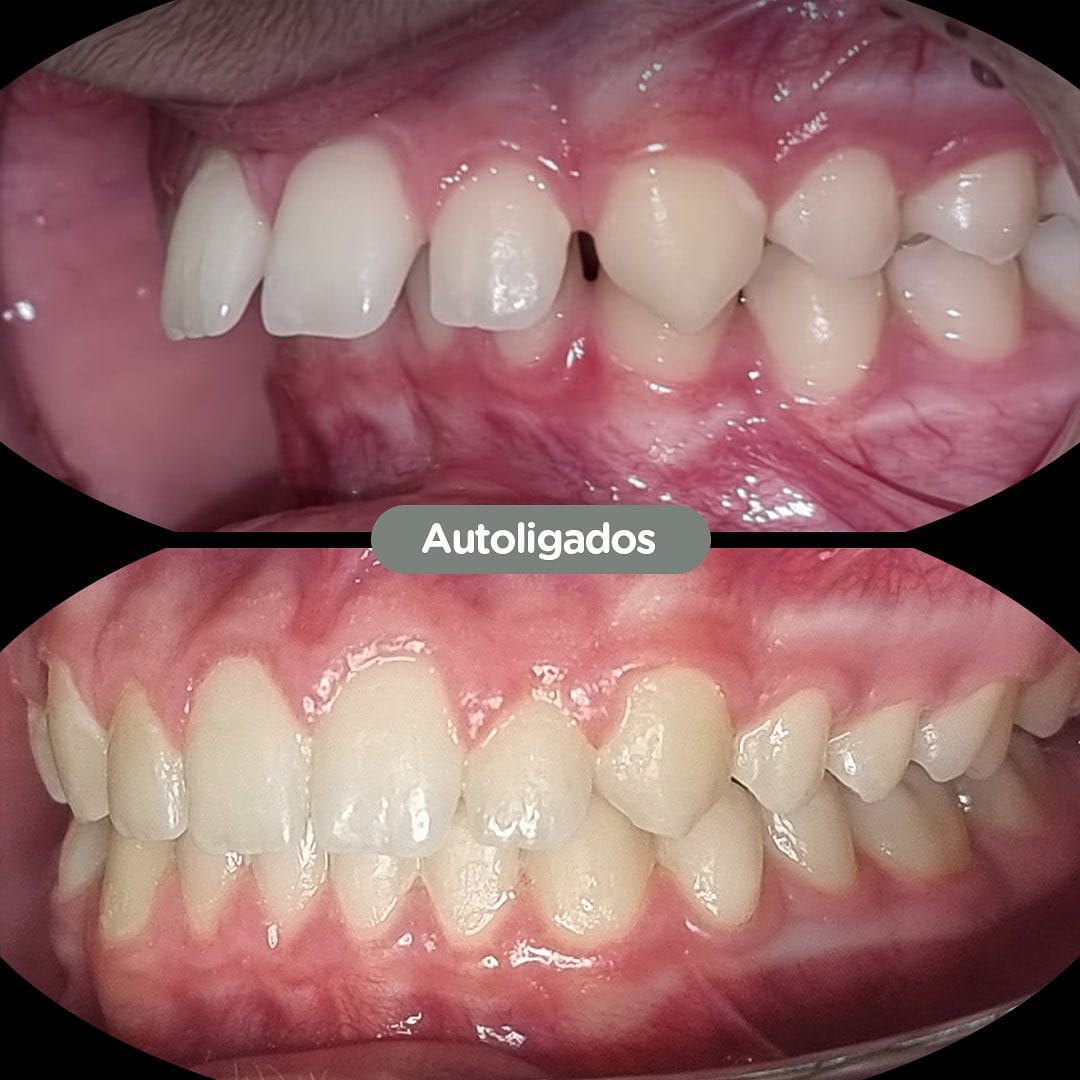 Antes y después con brackets autoligados Sistema CCO en Dental Group Panama