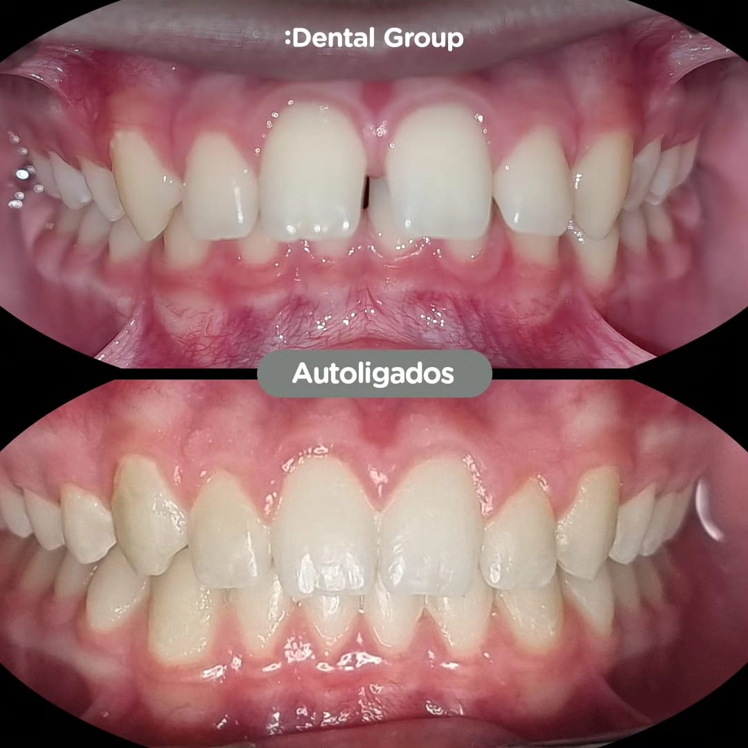 Antes y después con brackets autoligados Sistema CCO en Dental Group Panama