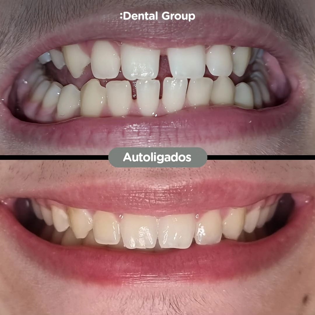 Antes y después con brackets autoligados Sistema CCO en Dental Group Panama