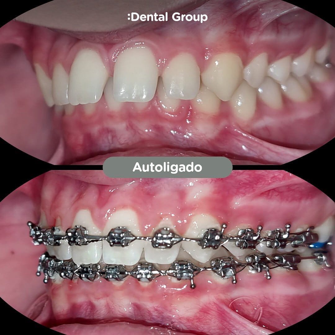 Antes y después con brackets autoligados Sistema CCO en Dental Group Panama