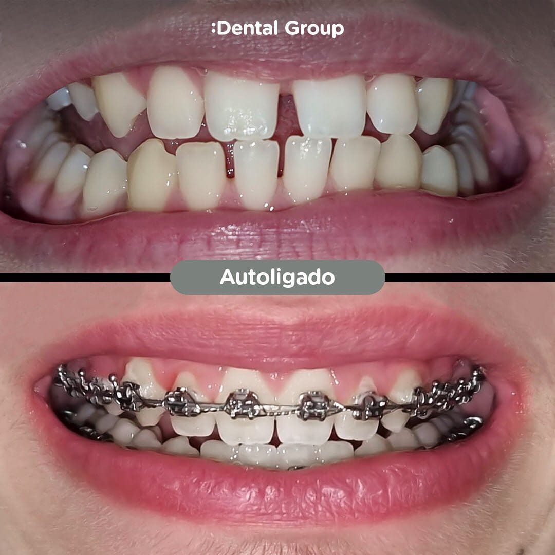 Antes y después con brackets autoligados Sistema CCO en Dental Group Panama