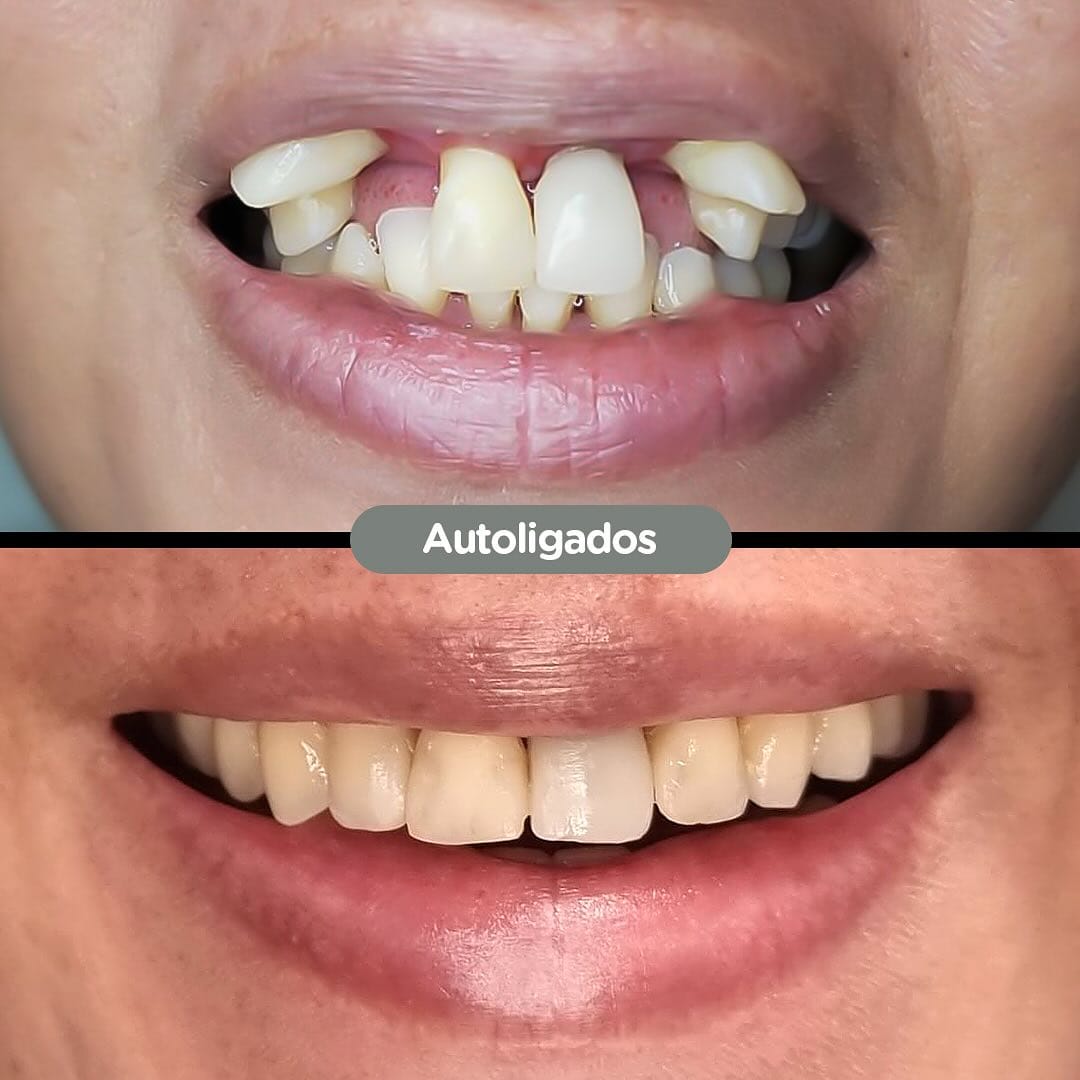 Resultado de Brackets linguales en Dental Group Panama