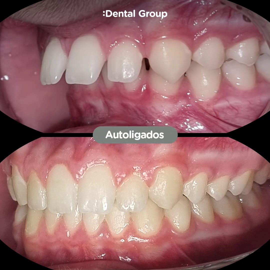 Antes y después con brackets autoligados Sistema CCO en Dental Group Panama