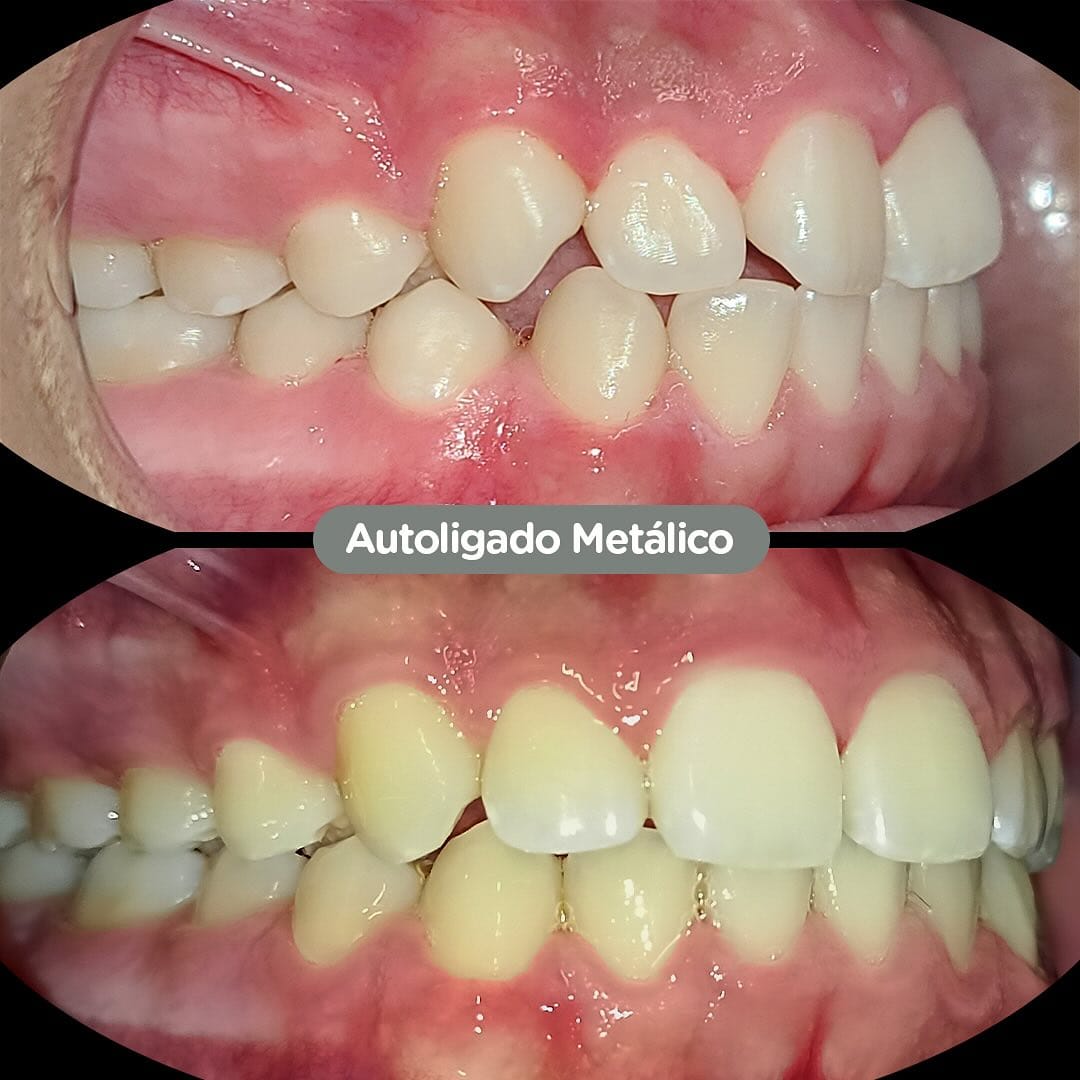 Antes y después con brackets autoligados Sistema CCO en Dental Group Panama