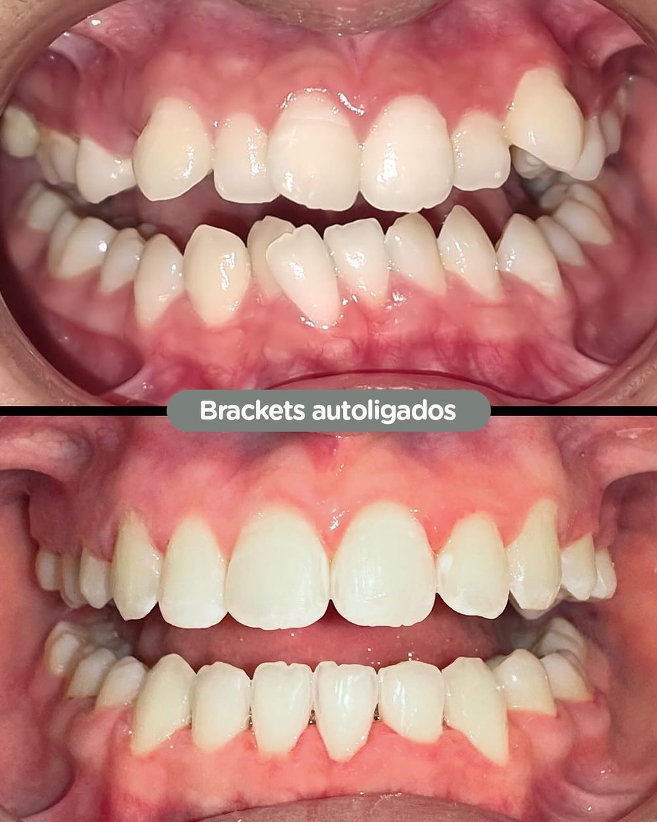 Antes y después con brackets autoligados Sistema CCO en Dental Group Panama