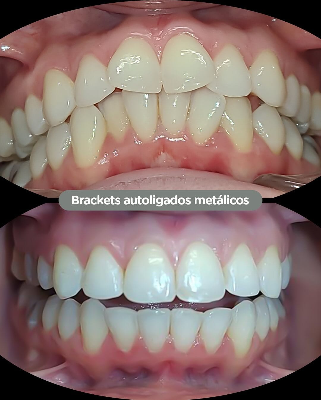 Antes y después con brackets autoligados Sistema CCO en Dental Group Panama