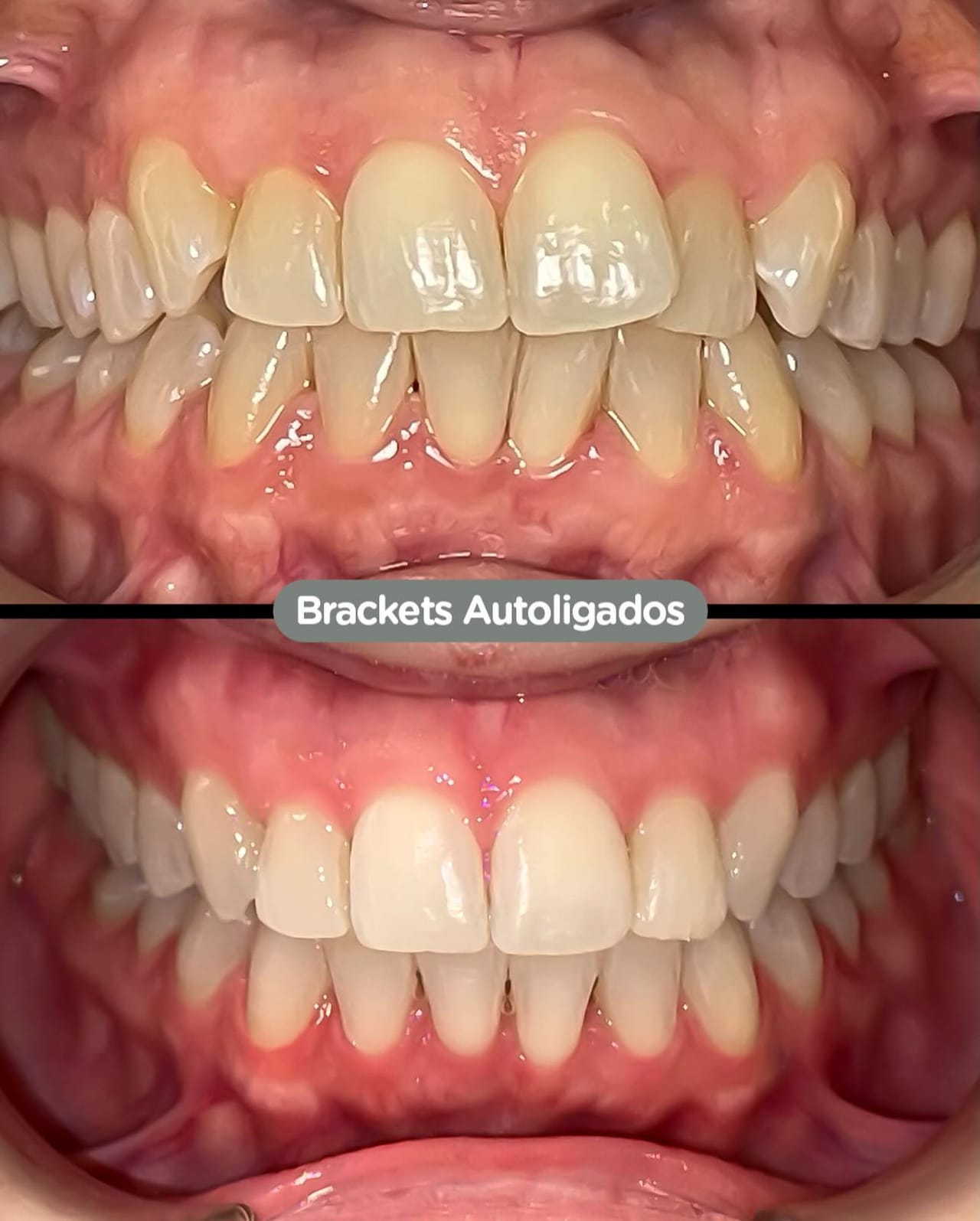Antes y después con brackets autoligados Sistema CCO en Dental Group Panama