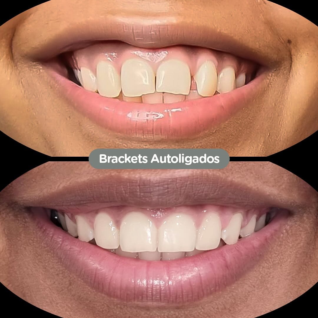 Antes y después con brackets autoligados Sistema CCO en Dental Group Panama