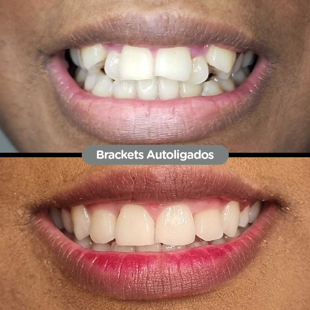 Antes y después con brackets autoligados Sistema CCO en Dental Group Panama