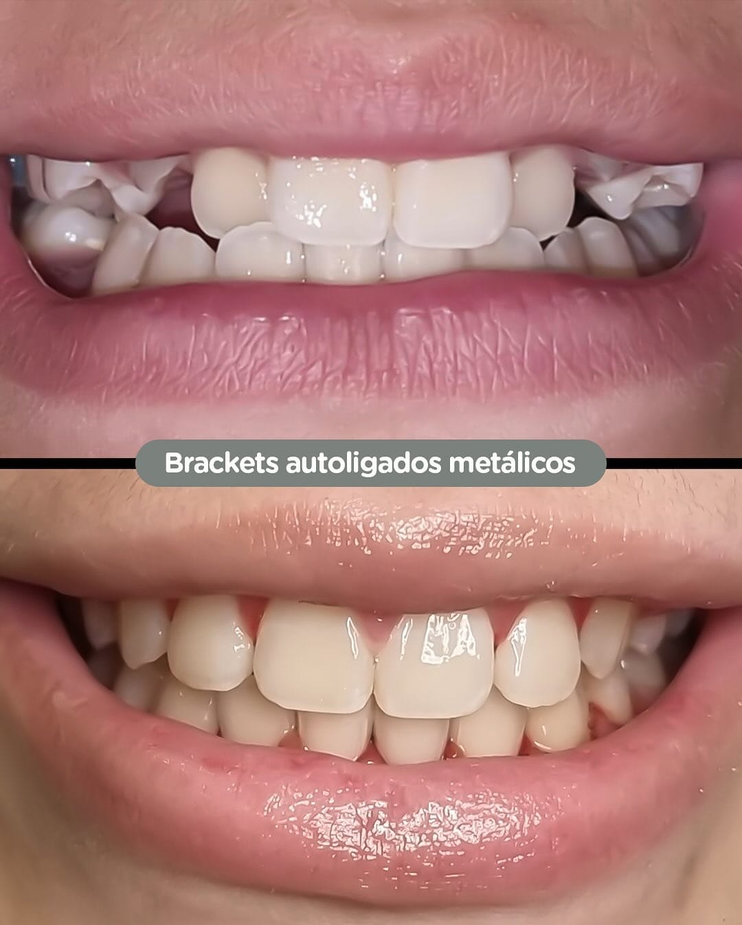 Antes y después con brackets autoligados Sistema CCO en Dental Group Panama