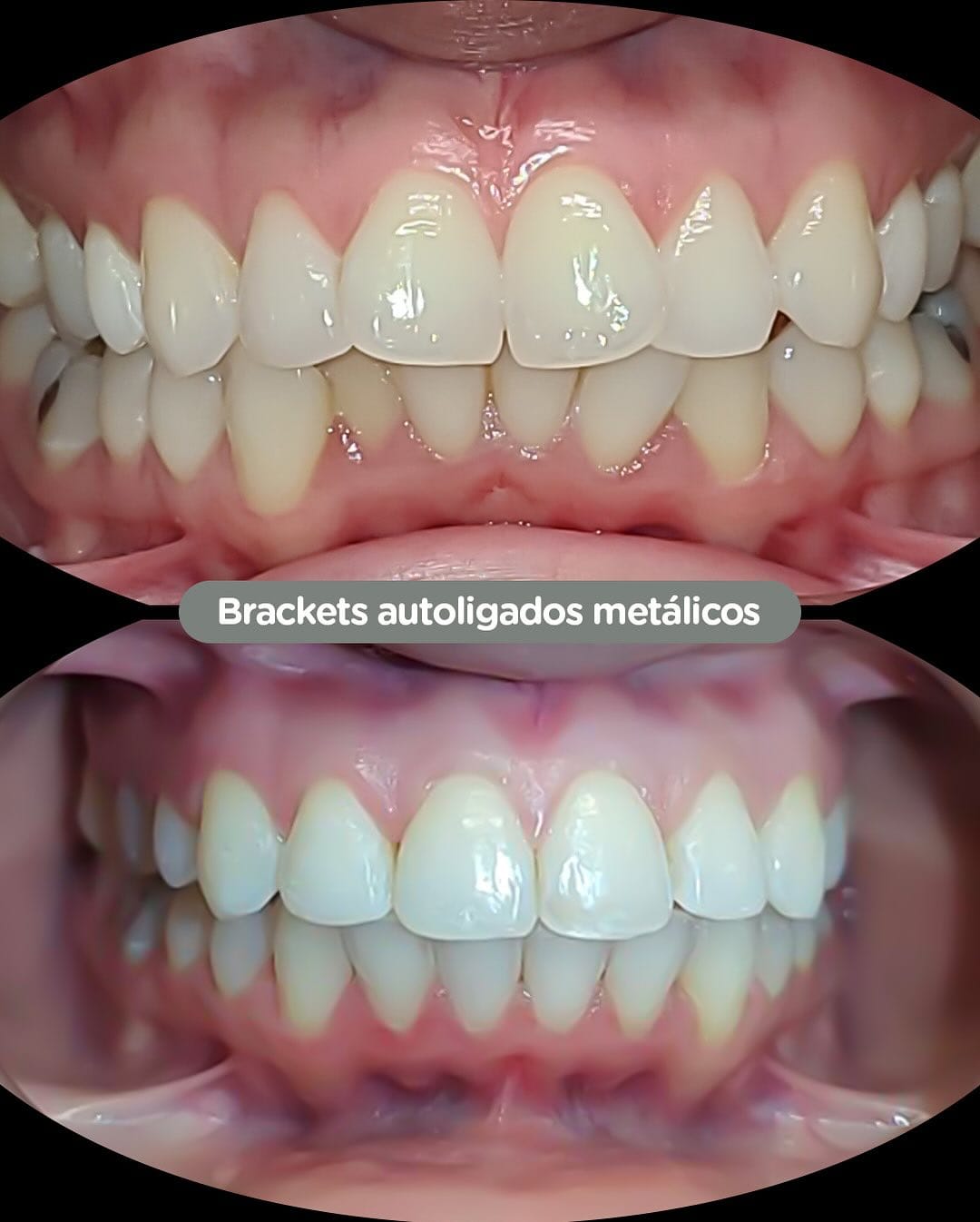 Antes y después con brackets autoligados Sistema CCO en Dental Group Panama