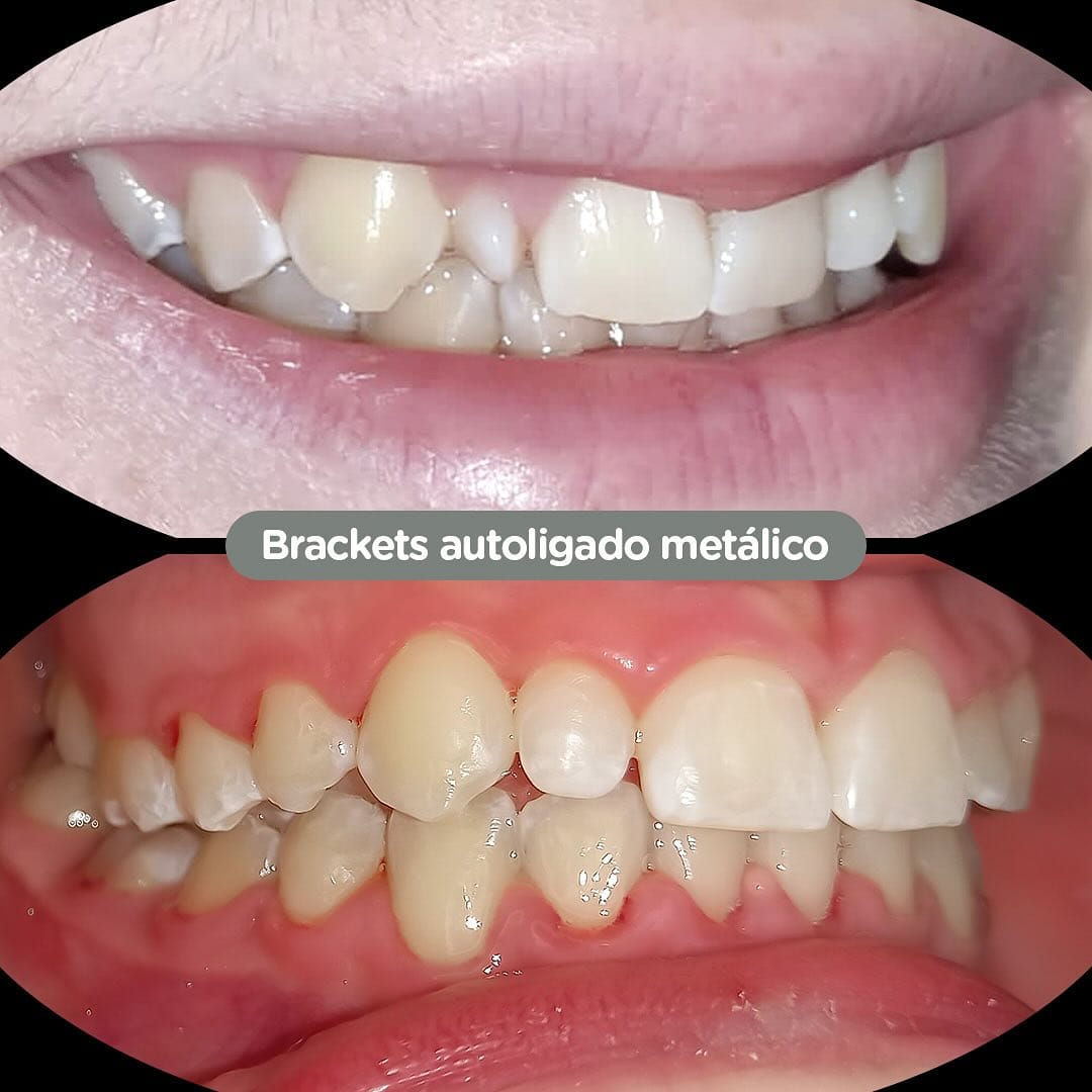 Antes y después con brackets autoligados Sistema CCO en Dental Group Panama