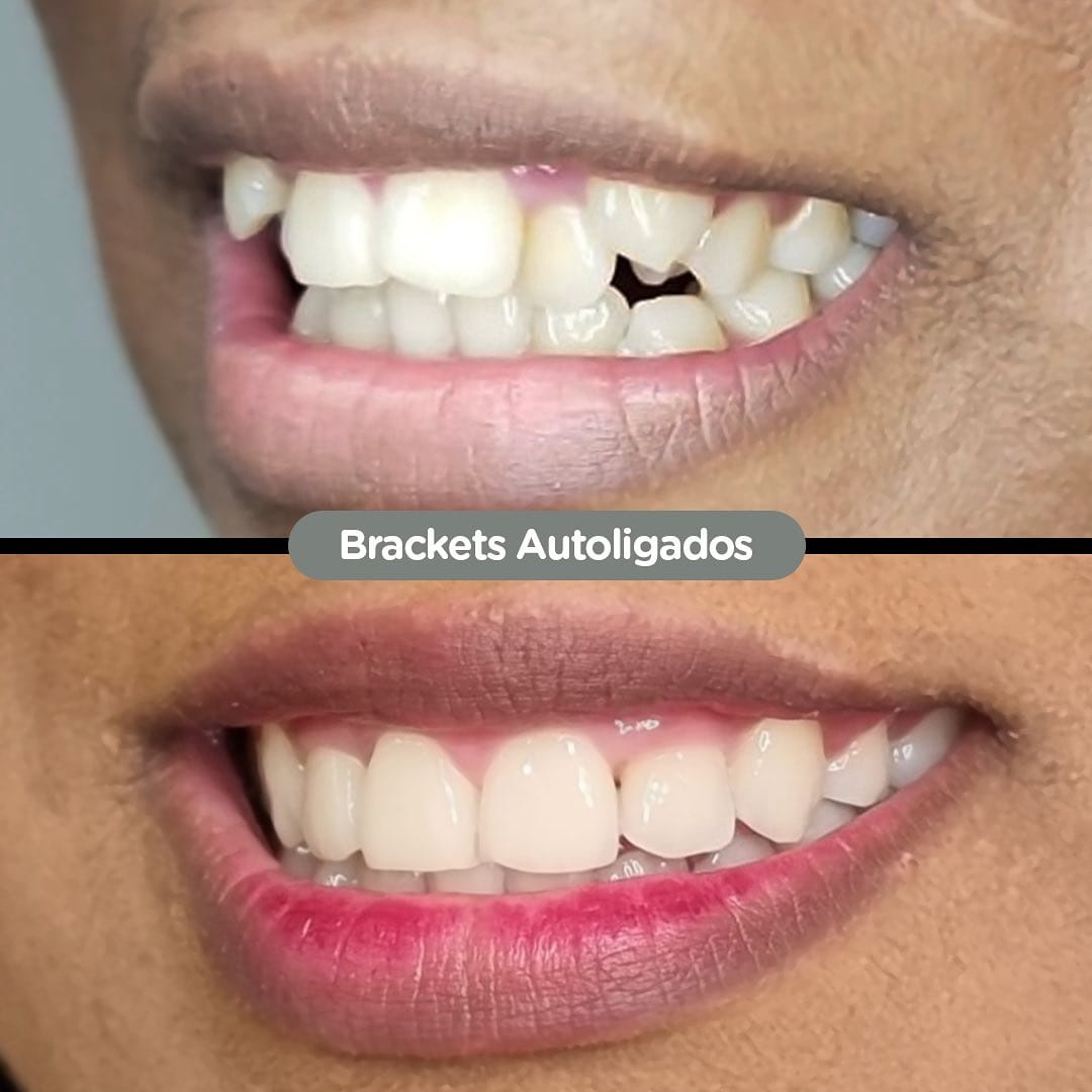 Antes y después con brackets autoligados Sistema CCO en Dental Group Panama