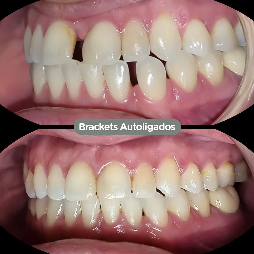 Antes y después con brackets autoligados Sistema CCO en Dental Group Panama