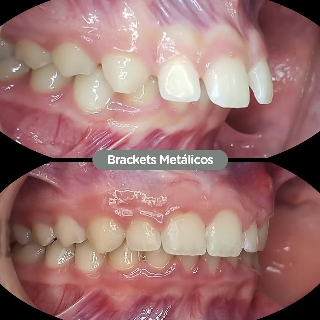 Resultado de Brackets metálicos en Dental Group Panama