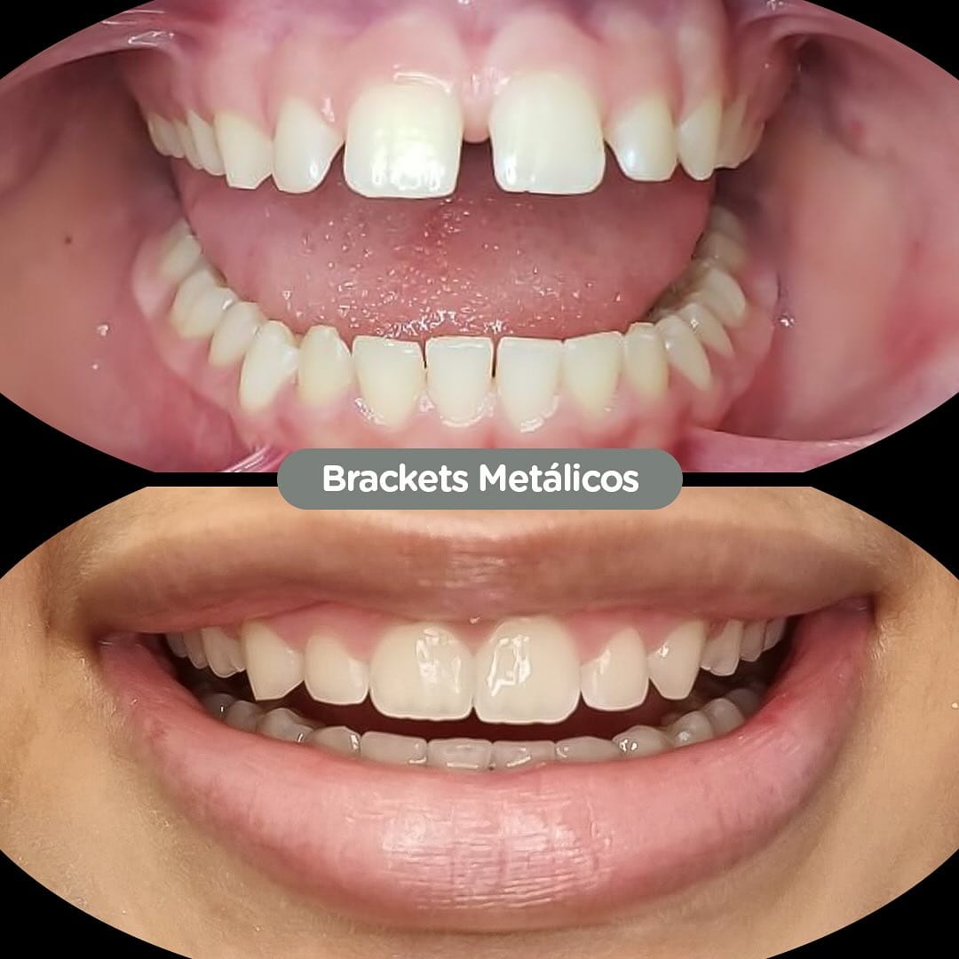 Antes y después con brackets metálicos en Dental Group Panama