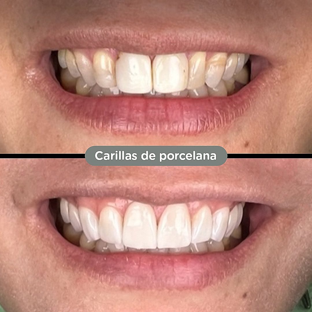 Resultado de Carillas de porcelana en Dental Group Panama