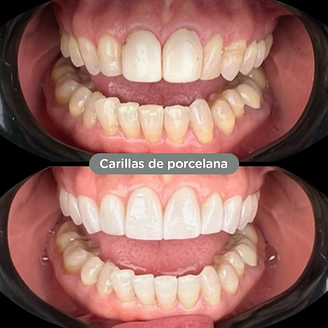 Resultado de Coronas y puentes en Dental Group Panama