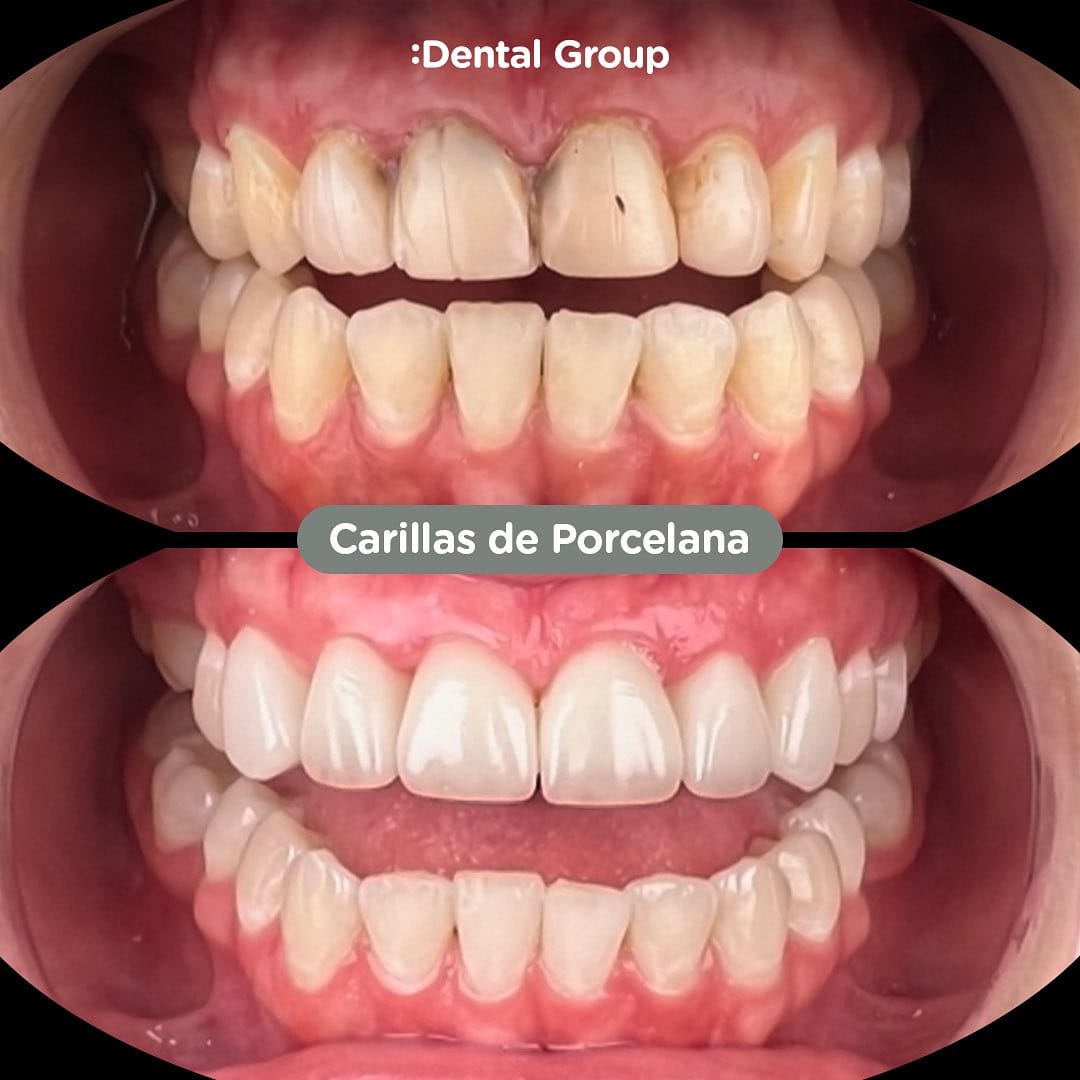Antes y después de carillas de porcelana en Dental Group Panama