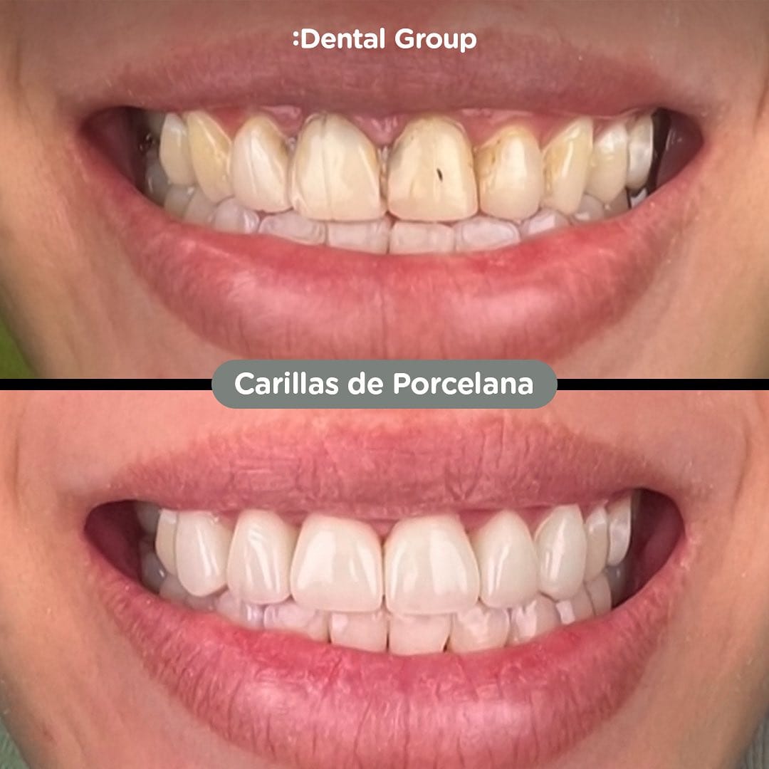 Antes y después de carillas de porcelana en Dental Group Panama