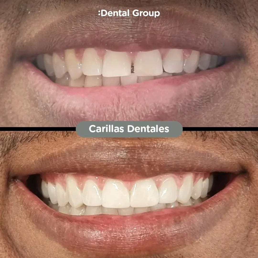 Antes y después de carillas de porcelana en Dental Group Panama