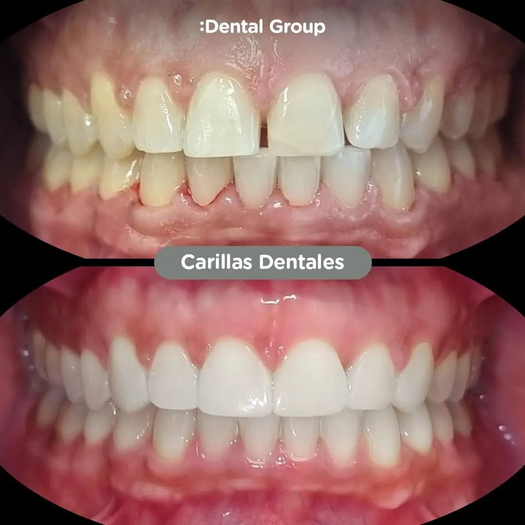 Antes y después de carillas de porcelana en Dental Group Panama