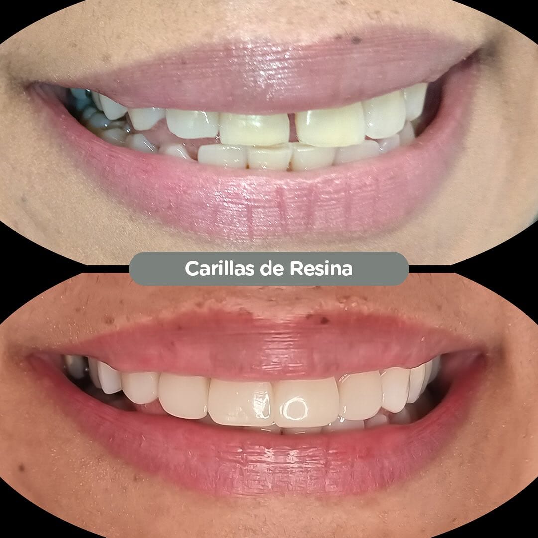 Resultado de Carillas de resina en Dental Group Panama