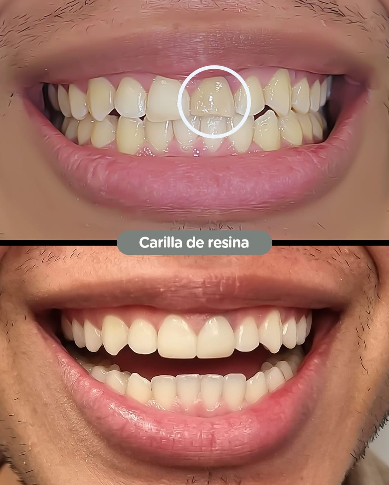 Antes y después de carillas de resina en Dental Group Panama