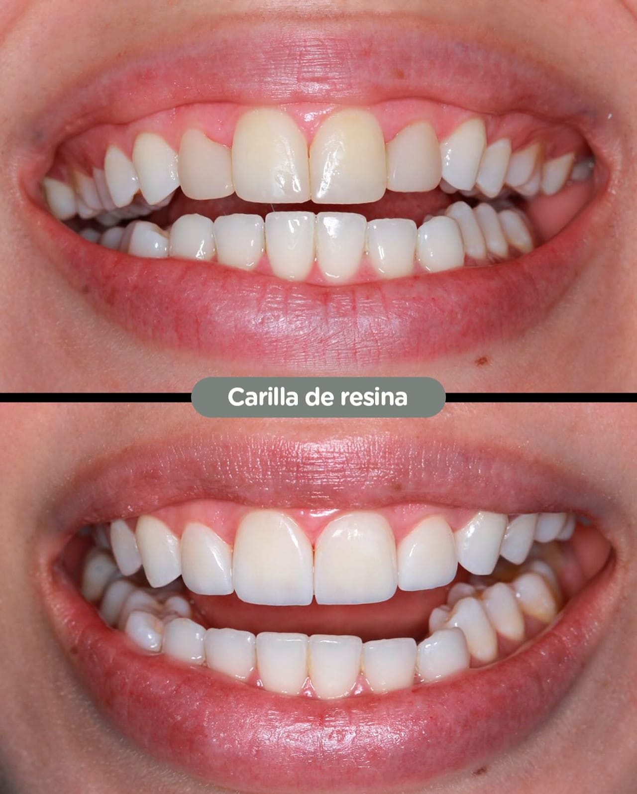 Antes y después de carillas de resina en Dental Group Panama