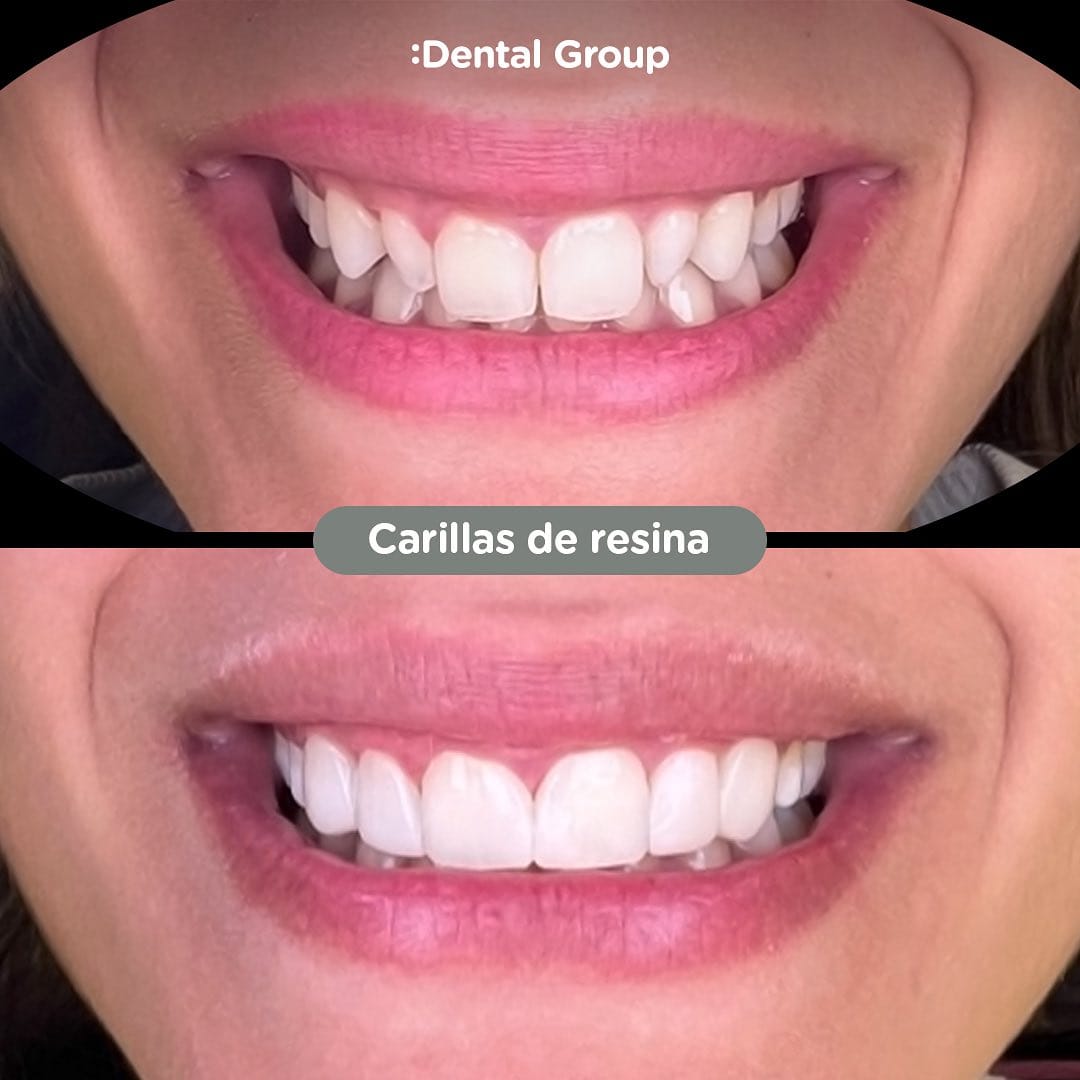 Antes y después de carillas de resina en Dental Group Panama