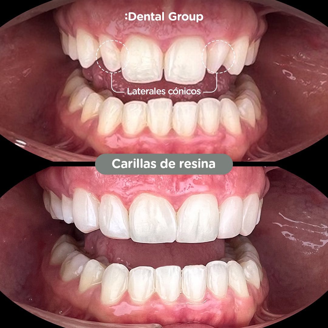 Antes y después de carillas de resina en Dental Group Panama