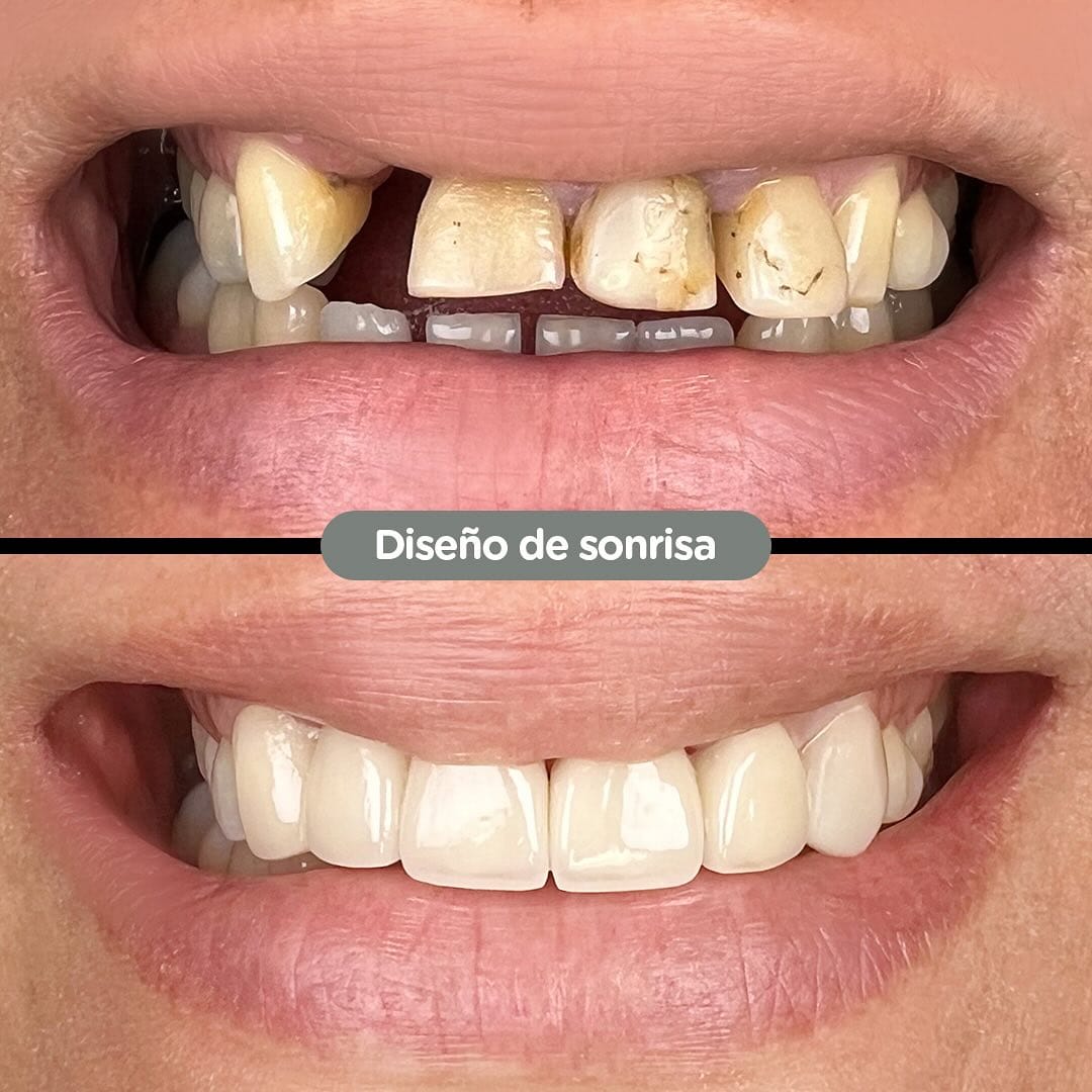 Resultado de Corrección de sonrisa gingival en Dental Group Panama