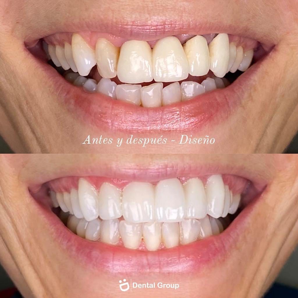 Antes y después de diseño de sonrisa en Dental Group Panama